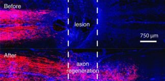 Research: A recipe for regenerating nerve fibers across complete spinal cord injury —