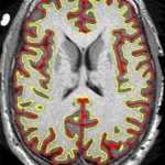 Study: Trial offers hope for disease with limited treatment options — (Details)