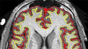 Study: Trial offers hope for disease with limited treatment options — (Details)