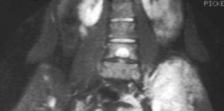 Study: Complex genetic rearrangements found which could inform treatment — (Details)