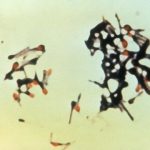 Study: Study illustrates challenges of lowering tetanus mortality — (Details)