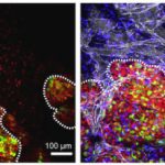 Study: A master switch controls aggressive breast cancer — (Details)