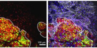 Study: A master switch controls aggressive breast cancer — (Details)