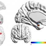 Study: Looking inside the brain to distinguish bipolar from depression — (Details)