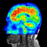 Study: Novel strategy shows promise for earlier detection of Alzheimer’s disease — (Details)