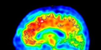 Study: Novel strategy shows promise for earlier detection of Alzheimer’s disease — (Details)