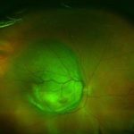 Study: Plant compound shuts down tumor growth — (Details)