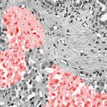 Study: New way to identify telltale markers for breast cancer tumors — (Details)