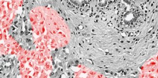 Study: New way to identify telltale markers for breast cancer tumors — (Details)