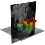 Study: 3-D virtual simulation gets to the ‘heart’ of irregular heartbeats — (Details)