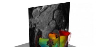 Study: 3-D virtual simulation gets to the ‘heart’ of irregular heartbeats — (Details)