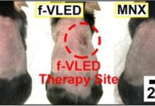 Tech: A wearable device for regrowing hair — (Report)