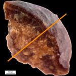 Study: Kidney stones have distinct geological histories — (Details)