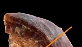 Study: Kidney stones have distinct geological histories — (Details)