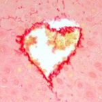 Study: Researchers identify enzyme as responsible for onset and progression of fatty liver disease in mice and human clinical specimens — (Details)