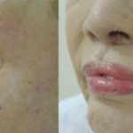 Study: Preliminary study suggests cosmetic improves self-perception in patients with facial scarring — (Details)