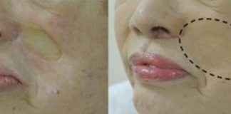 Study: Preliminary study suggests cosmetic improves self-perception in patients with facial scarring — (Details)