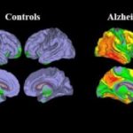 Study: New method enables accurate diagnosis of Alzheimer’s disease — (Details)