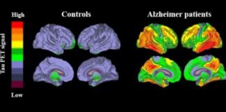 Study: New method enables accurate diagnosis of Alzheimer’s disease — (Details)