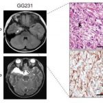 Study: New therapeutic target of intractable epilepsy identified — (Details)