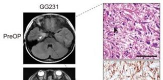 Study: New therapeutic target of intractable epilepsy identified — (Details)