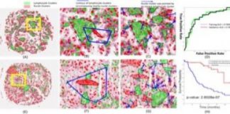 Study: Looking to immune cell shapes to predict how well body will fight lung cancers — (Details)