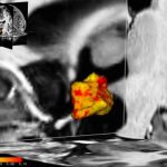 Study: In depression the brain region for stress control is larger — (Details)