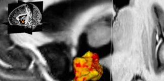 Study: In depression the brain region for stress control is larger — (Details)