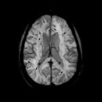 Study: New cause of brain bleeds identified — (Details)