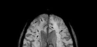 Study: New cause of brain bleeds identified — (Details)