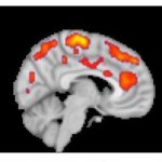Study: PET imaging studies reveal elevated glial activation, correlation with fatigue levels — (Details)