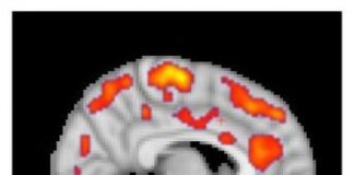 Study: PET imaging studies reveal elevated glial activation, correlation with fatigue levels — (Details)