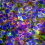 Study: Aggressive prostate and lung cancers are driven by common mechanisms, researchers find — (Details)