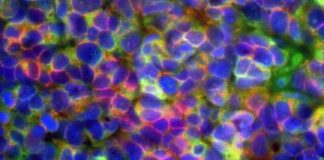 Study: Aggressive prostate and lung cancers are driven by common mechanisms, researchers find — (Details)