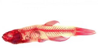 Study: Children with severely curved spines may be unable to use manganese — (Details)