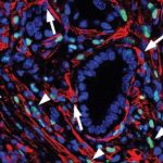 Study: Turning cells against pancreatic cancer — (Details)