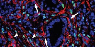 Study: Turning cells against pancreatic cancer — (Details)