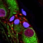 Study: Appendix acts as a reservoir for disease-associated proteins; appendectomy lowers the risk of developing Parkinson’s — (Details)