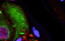 Study: Appendix acts as a reservoir for disease-associated proteins; appendectomy lowers the risk of developing Parkinson’s — (Details)