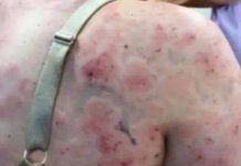 Mother In Australia battered by hailstorm as tornado Mother In Australia battered by hailstorm as tornado