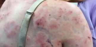 Mother In Australia battered by hailstorm as tornado Mother In Australia battered by hailstorm as tornado