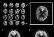 Tech: Artificial intelligence predicts Alzheimer’s years before diagnosis — (Report)