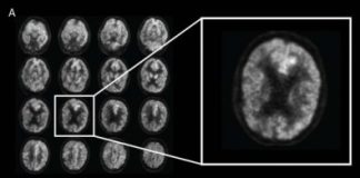 Tech: Artificial intelligence predicts Alzheimer’s years before diagnosis — (Report)