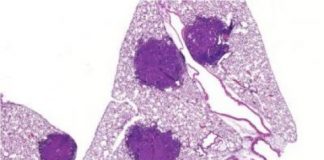 Study: Scientists find how the enzyme AMPK, largely thought to suppress cancer, actually helps some tumors survive — (Details)