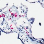 Study: Mothers infected by dengue may have babies with higher risk of severe Zika, and vice versa — (Details)