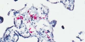 Study: Mothers infected by dengue may have babies with higher risk of severe Zika, and vice versa — (Details)