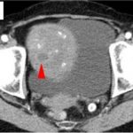 Study: Role of circulating tumor DNA to detect early melanoma growth — (Details)