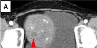Study: Role of circulating tumor DNA to detect early melanoma growth — (Details)