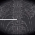 Study: Pulsed radiofrequency relieves acute back pain and sciatica — (Details)