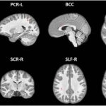 Study: Youth football changes nerve fibers in brain — (Details)